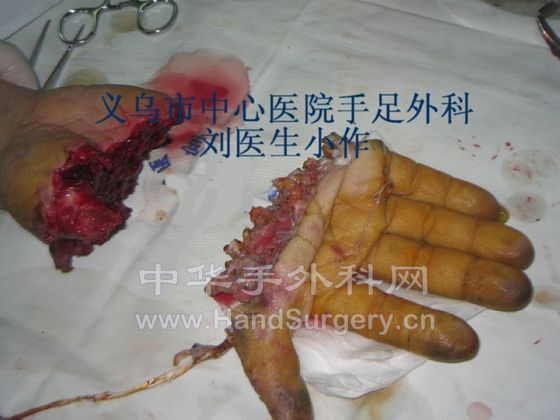 撕脱性断掌再植 (1).JPG