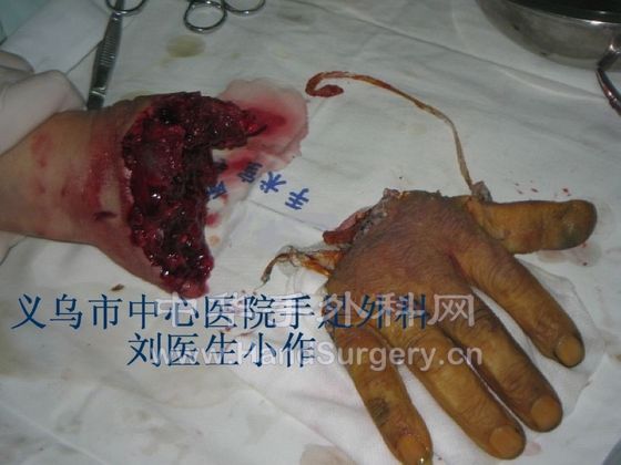 撕脱性断掌再植 (2).JPG