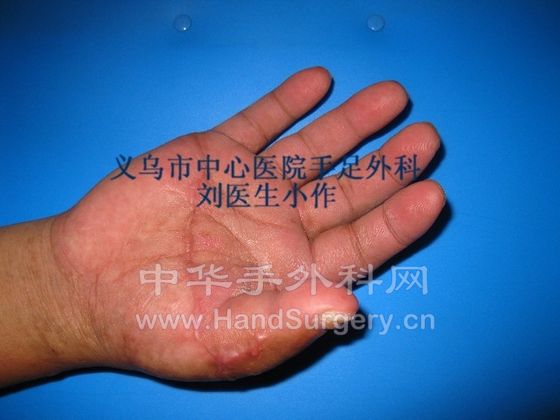 撕脱性断掌再植 (3).JPG