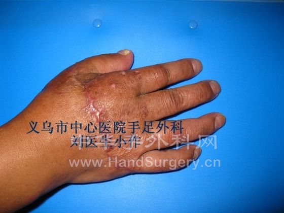撕脱性断掌再植 (4).JPG