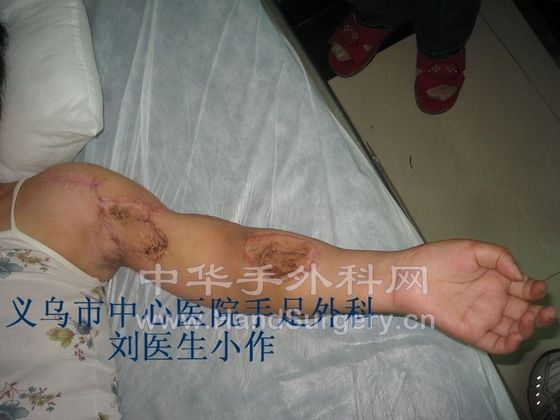 上臂离断术后8月-1.JPG