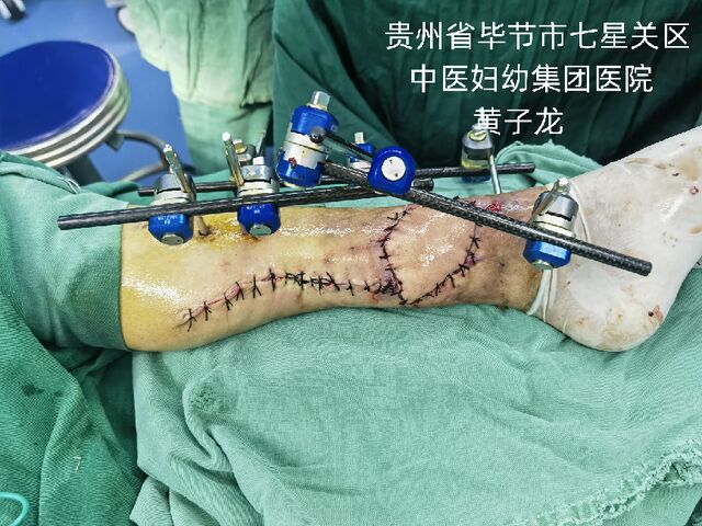 术后