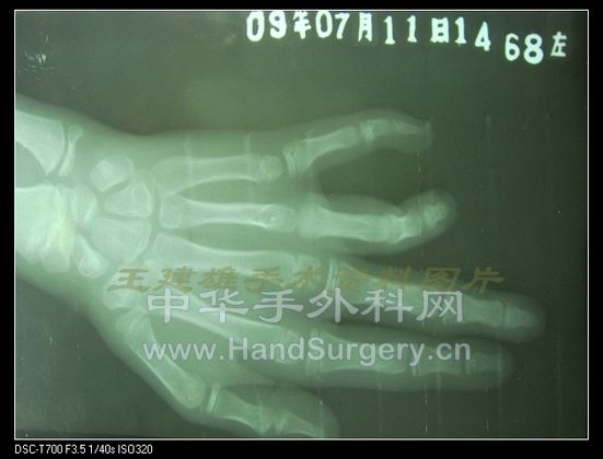 正位示第4、5掌骨发育不良，第4掌骨头及近节指骨基底骨骺闭合可能，掌指关节关系不清 ...