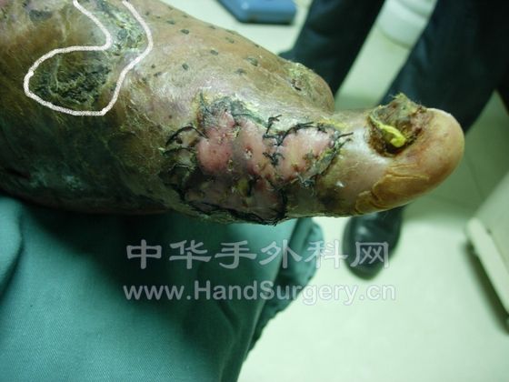 第二次植皮，皮瓣稳定后，给予石膏托外固定，试图纠正足下垂，效果不理想，但足背残余创面已结痂，足母囊关 ...