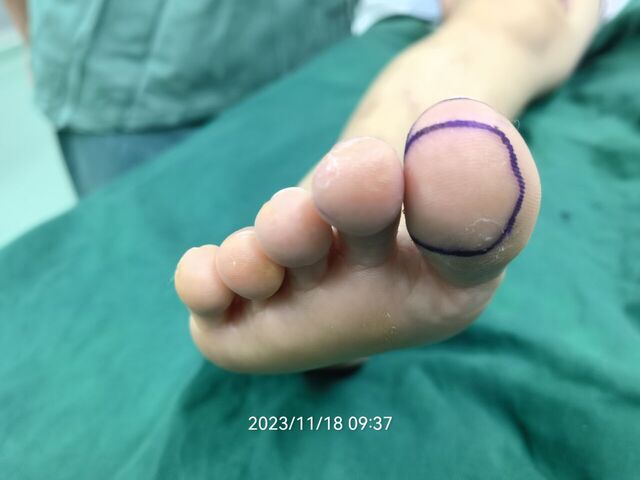 术前设计