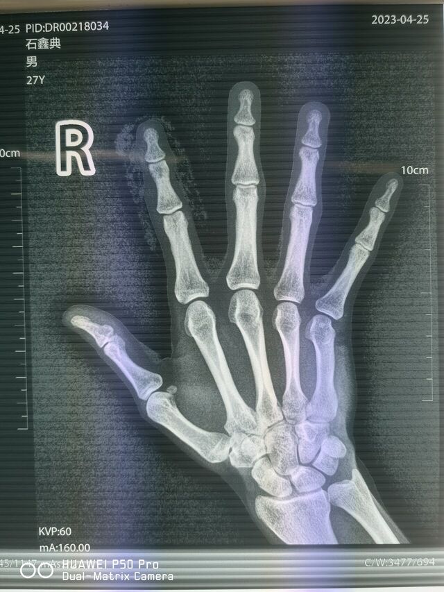 术前DR