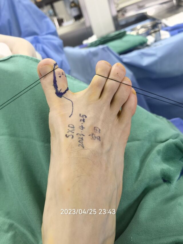 踇趾腓侧皮瓣术前设计