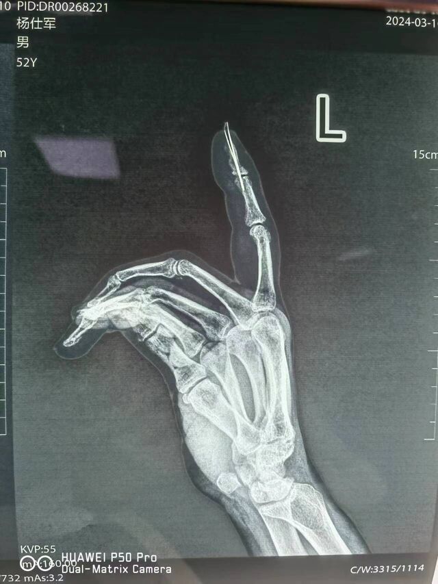 术后2个月DR