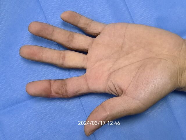 术后第71天。