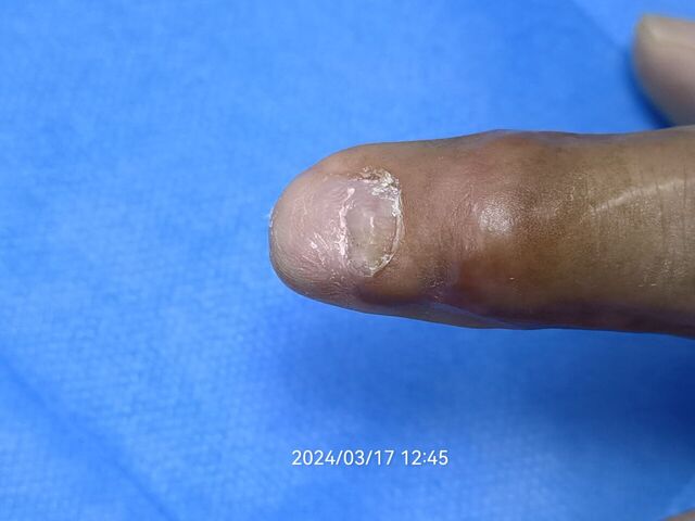 术后第71天。