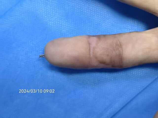 术后64天