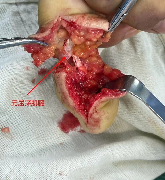 未见屈深肌腱