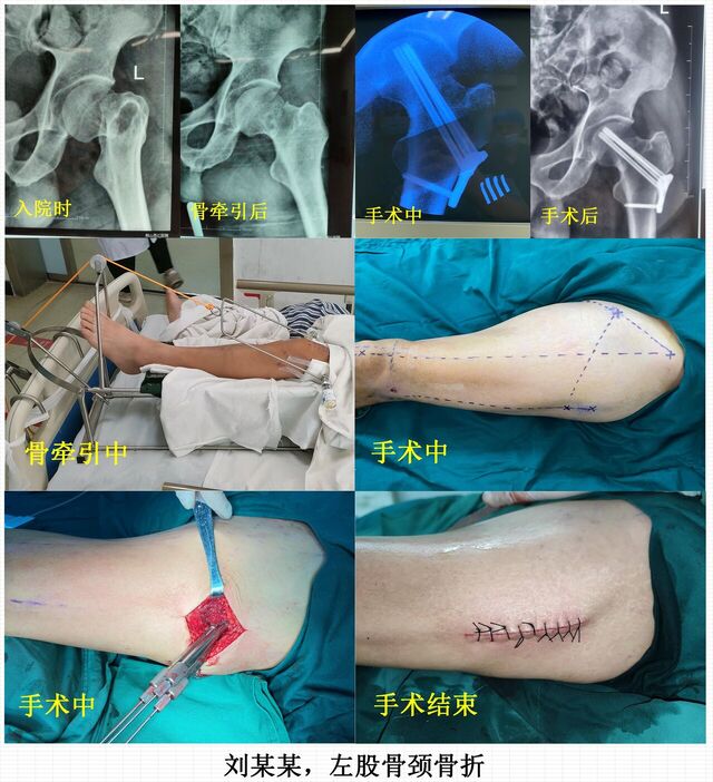 股骨颈骨折2.jpg