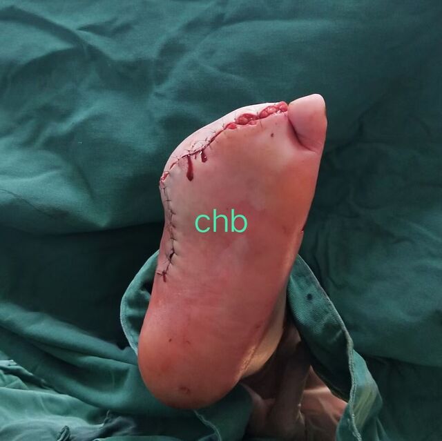 足底