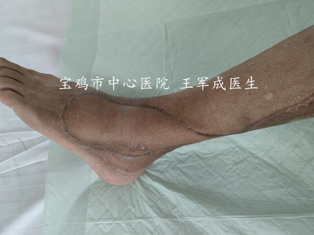 术后3月患者门诊复查
