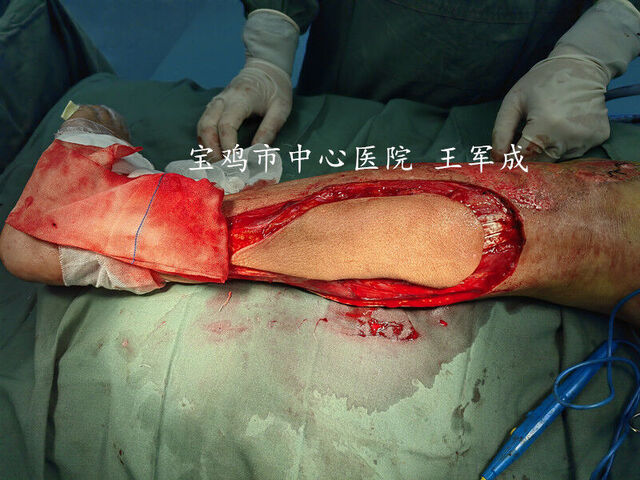 皮瓣切取后血运良好