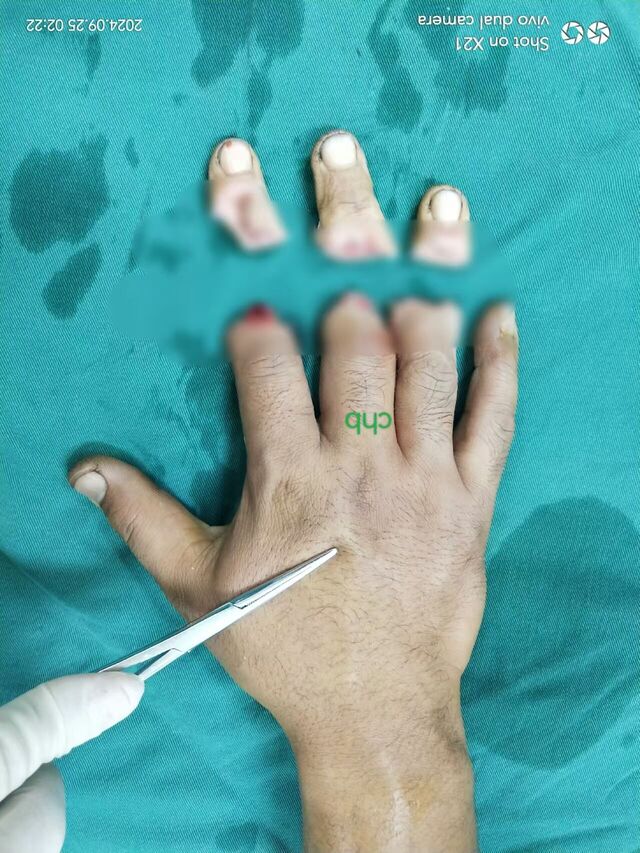 背侧