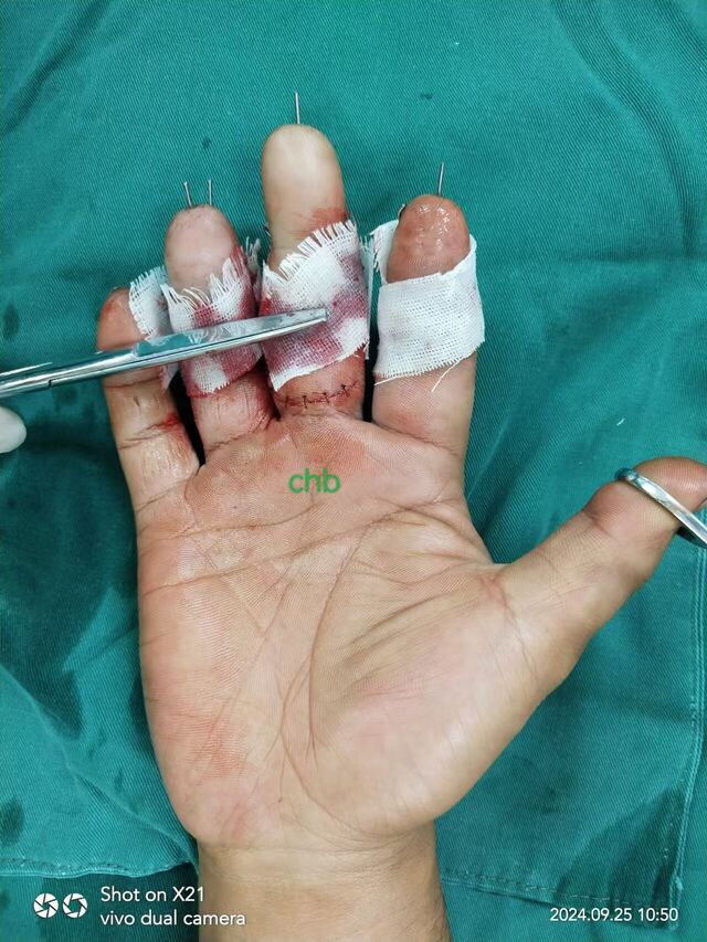 术后即刻