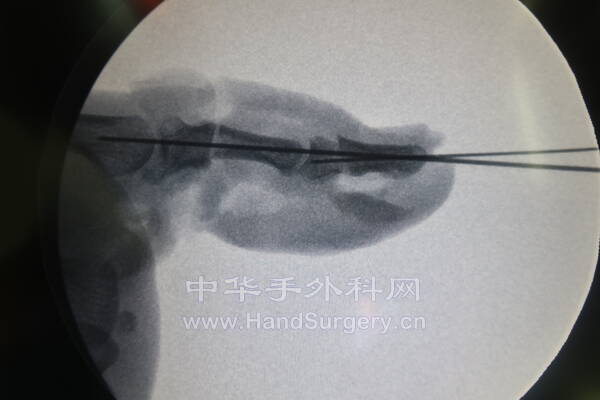 术中透视.JPG