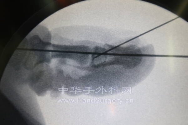 术中透视2.JPG