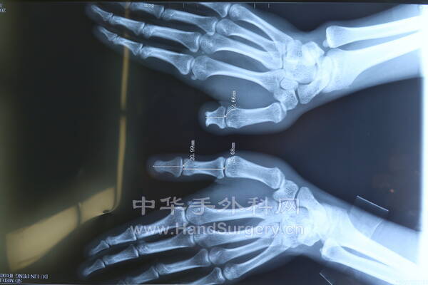 术前X线.JPG