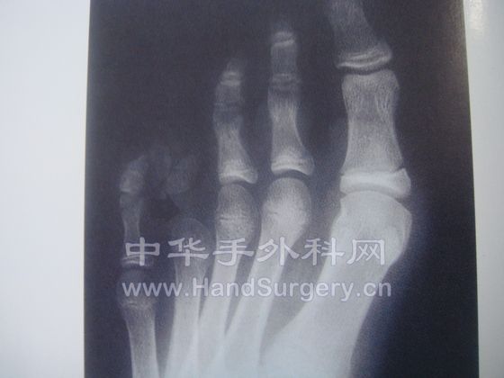 近节趾骨移植10年双足功能正常