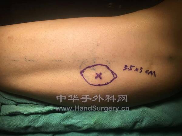 穿支多普勒定位