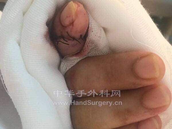 吻合直动脉以及指腹静脉