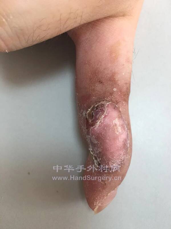 术后21天情况