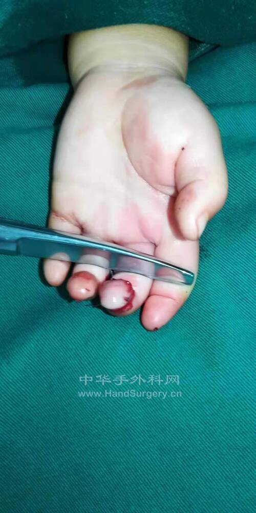 术后即刻