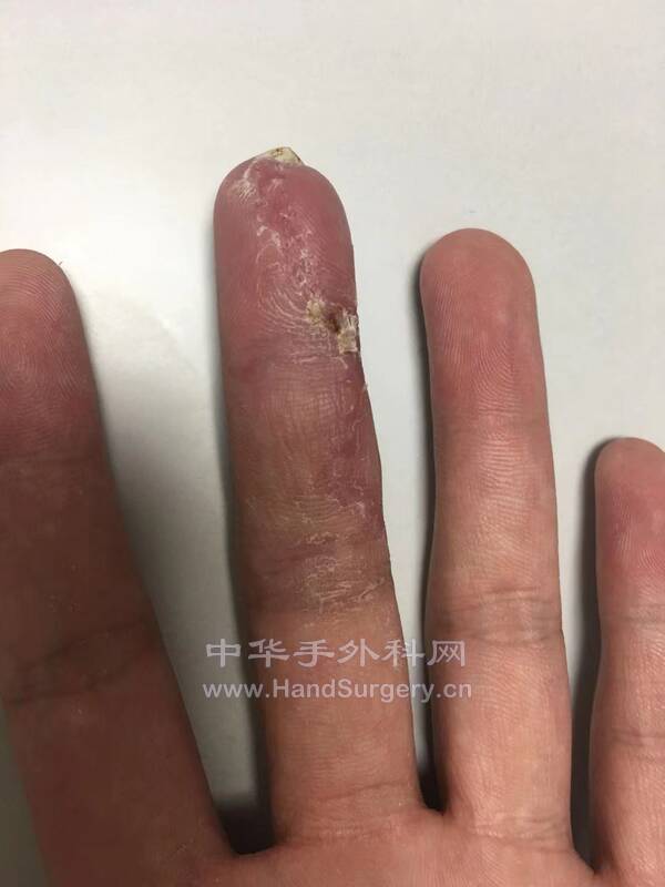 21天复诊