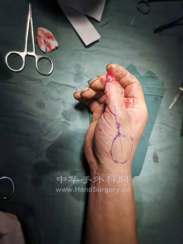 术中皮瓣设计
