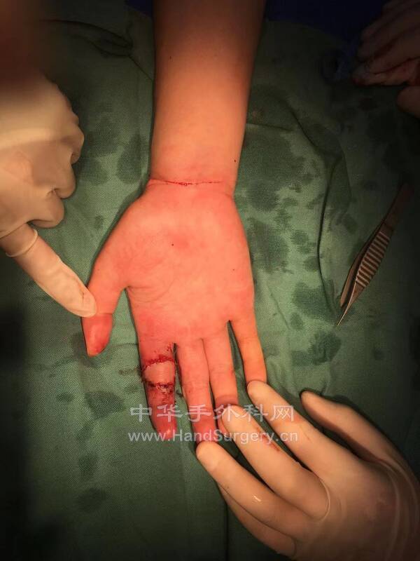 疤痕挛缩游离腕横纹皮瓣4.jpg