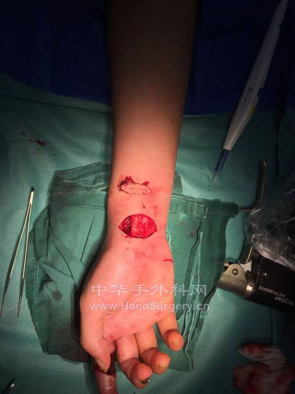 疤痕挛缩游离腕横纹皮瓣3.jpg