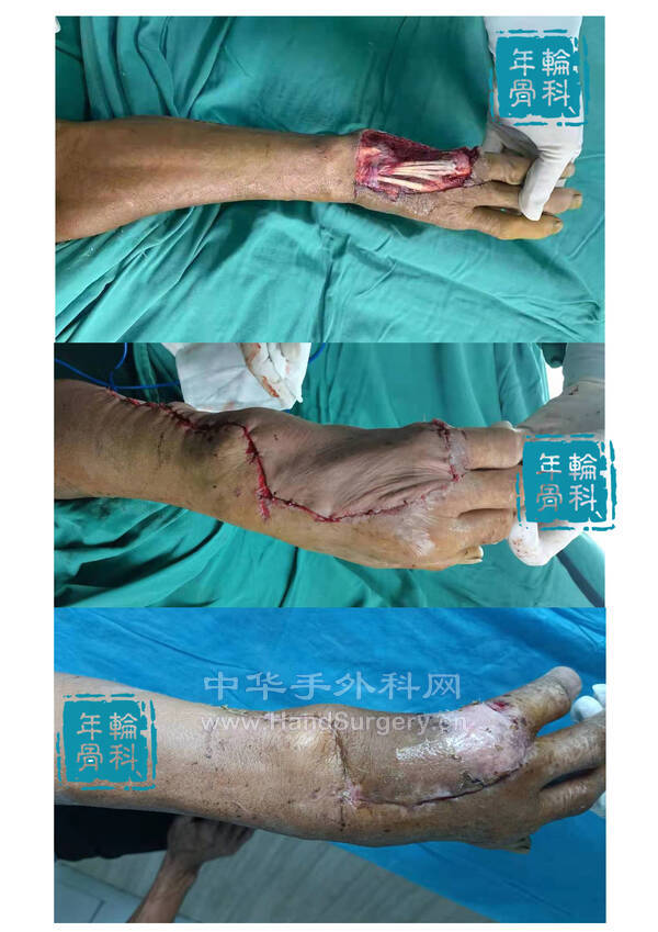 尺动脉腕上穿支皮瓣.jpg