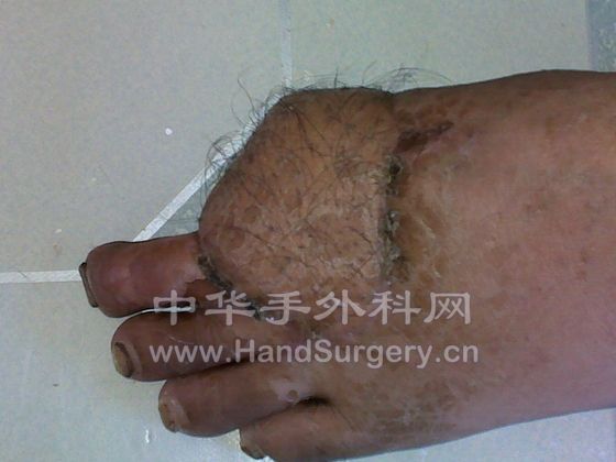 断蒂后照片
