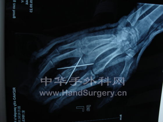术后1