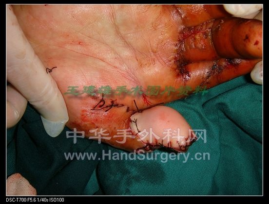 术中通血后血运情况