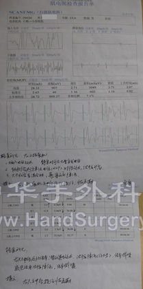 3_第二次肌电图.jpg