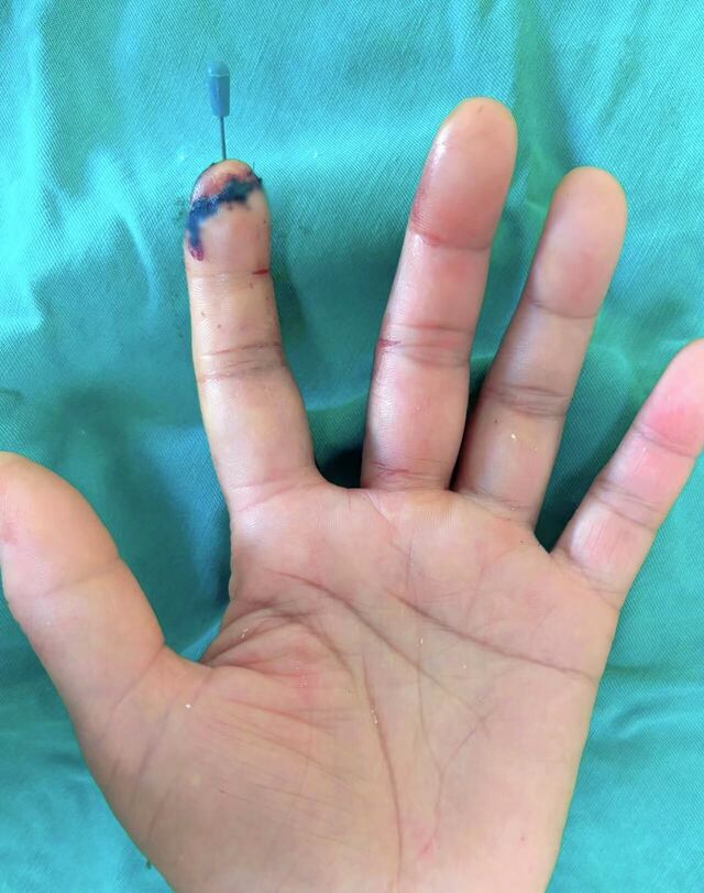 术后7天
