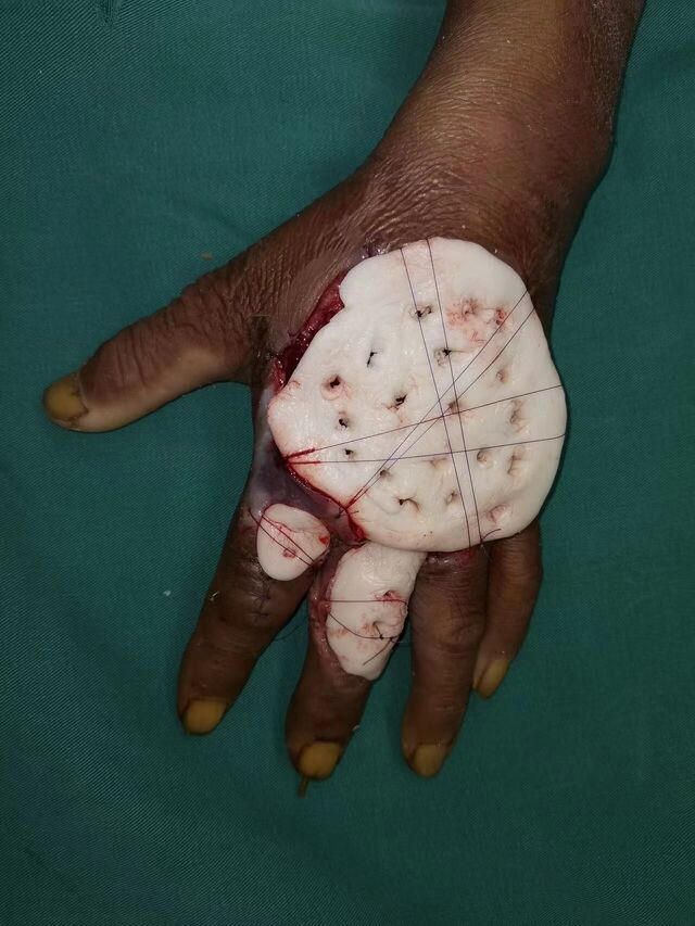 二期皮肤坏死骨水泥覆盖