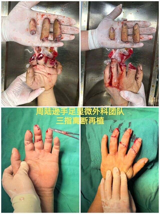 三指离断再植