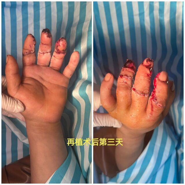 再植术后第三天，血运良好