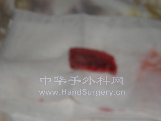 术中取的髂骨约2，5cm