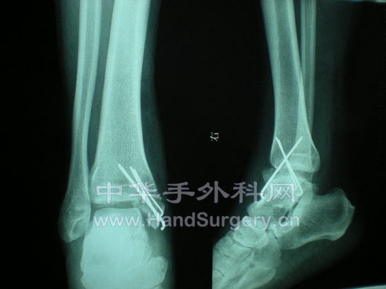术后X情况