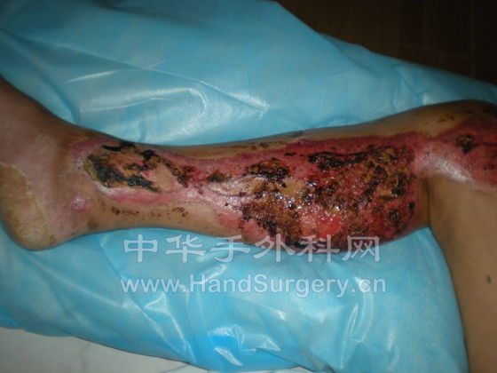 今天患者右小腿情况