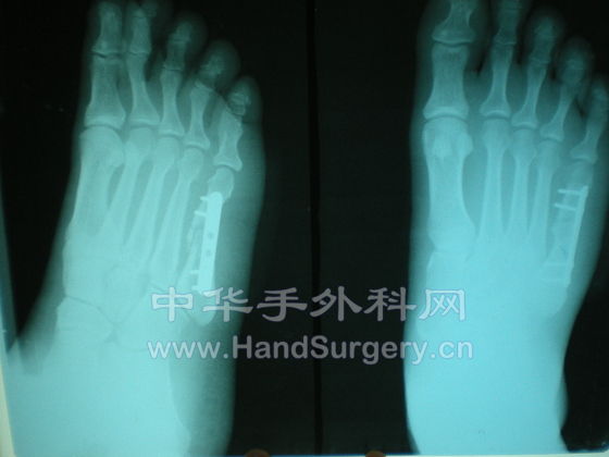 术后X情况