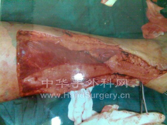 腓肠神经皮瓣术中.jpg