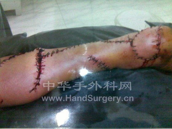 腓肠神经皮瓣术后.jpg