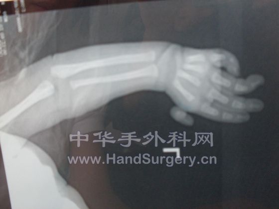 左手拇指漂浮拇